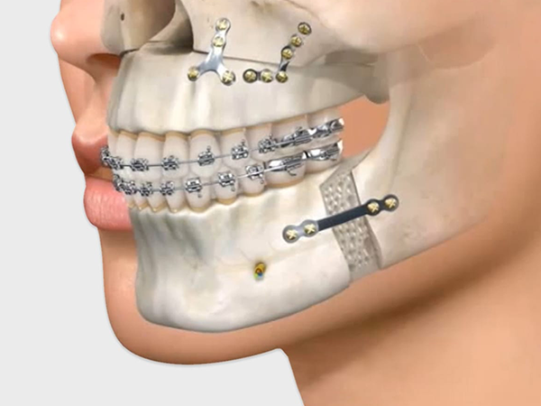 RECUO MAXILO-MANDIBULAR - CLINICA DA FACE